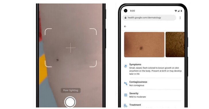 Google I/O 2021：用 AI 搭配手機鏡頭，拍張照就可以辨識你皮膚上的斑點是否是疾病