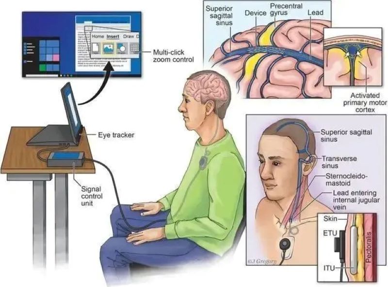 馬斯克的腦機介面公司 Neuralink 要搞人體試驗，意念控制不會要來了吧？